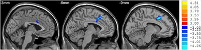 Changed Resting-State Brain Signal in Parkinson's Patients With Mild Depression